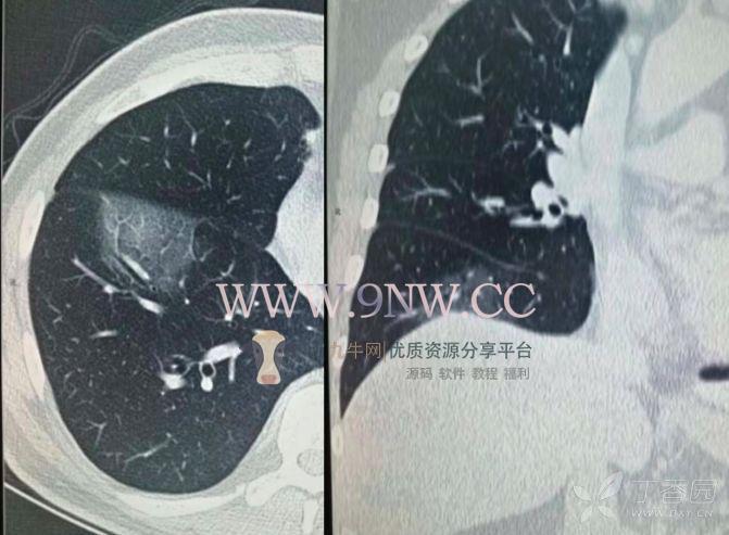 新型冠状病毒肺炎快速诊疗指南！,第2张